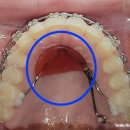 밝은미소 SN치과의원 | 안성 치아교정전문의 "오빠 교정 너무 잘돼서, 저도 교정 할래요" 가위교합·과개교합 후기