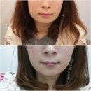 [턱 보톡스] 청담비아이 에서 보톡스 후기