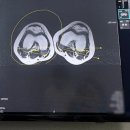 우리정형외과 | 어린이안짱다리 원병원 소아정형외과 다녀온 후기 (MRI비용)