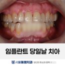 바로심는치과의원 | 앞니임플란트를 심고 바로 치아를 넣어드린 케이스 | 대구 수성구 서울동행치과의원