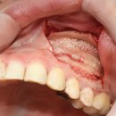 E-DENTAL | 대구 치과 , 임플란트 수술 전 CT 촬영이필요한 이유는 무엇인가요?