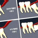 율전치과의원 | 치과선생님 사랑니 발치 후 질문이요