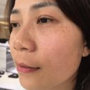 제네시스 레이저 후기 (기미잡티 주근깨 피부, 제네시스 레이저 효과, 잡티제거레이저 비용) 이미지