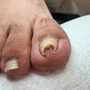 동성메디칼(주) | 금천내성발톱 병원보다 효과적인 포쉬네일 동성제약 풀리메디 족보있는그녀들 금천점