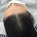 서초 | 강남헤어라인교정 닷센스 서초 후기 , 헤어라인교정 변화