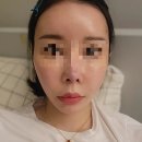 한지방 | 얼굴지방이식 리얼후기 붓기빨리빼는법 지방생착잘되는법알려드립니다