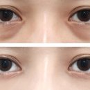 눈밑처짐 원인과 해결법, 탄력 되찾는 눈가 관리법 총정리 이미지