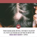 두피 화상/ 빨감 빨개짐 아픔 대처 방법은 이거죠 이미지