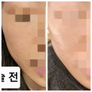 서울스타병원 | 청담동피부과 기미색소제거 || 압구정로데오 듀얼토닝 (피코웨이+스타워커) 후기