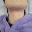 청주인모드 후기(FX) | 2회차 이중턱 개선 (내돈내산)