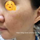 C-라움 | (광고X)2탄, 내돈으로 2회 만에 흑자 제거한 찐 리얼 후기(라움 성형외과)