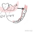 (썹스압) 사랑니 뽑고 담배 폈다가 드라이소켓 걸린 썰 이미지