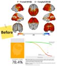 경도지질 | 경도인지장애 tPBM 케어 후기 – Before & After 변화, ATP 생성 증가, 혈류 개선,신경 염증 완화