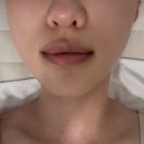 베스트올 분당오리점 | [분당피부관리 후기]오리역에스테틱 | 올가드림뷰티 | 문제성피부 개선