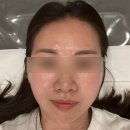 (주)휴안 | 영통피부관리 휴에스테틱에서 써마지관리 받은 후기