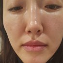 입술 주름 고민 끝! 필러+보톡스로 완성하는 매끈한 '볼륨 탄력' 입술 💋