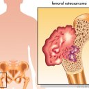 골육종 [osteosarcoma] 질환이란? 이미지