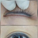 브라운성형외과의원 | 서울/교대역 | 브라운아이 의원 (수아미) 아이라인 반영구 제거 1회차 찐 후기, 1일차~7일차...