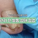 여보 방법은 이것밖에 없어😥 2탄!! 수술 대신 족보 그녀 오벨리를 선택! 오늘은 좌측발이에요^^ 이미지