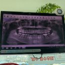 아침애치과의원 | 잠실숲사랑니/사랑니4개발치/아푸당