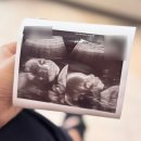 (주)미리본 | 임신 21주~25 기록 (갑자기 세브란스..?,단일제대동맥,임당검사,입체초음파)