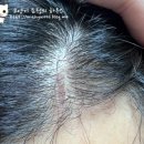 파이진박종옥에이전시 | 남편인생 첫 성형수술 후기 - 4. 내시경이마거상술+추미근 절제 후기(9일차 ~ 25일차 후기)