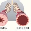 천식 증상 원인 및 치료 발작 완치 가능성은 이미지