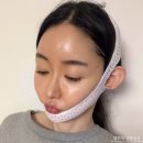 달 | 얼굴 실리프팅 붓기 한달 후기, 턱선리프팅 피부과추천