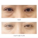 보름 | 눈밑지 눈밑지방재배치 지방제거 시술 보름차 후기