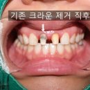 시민치과의원 | 앞니 실활치 미백 + 크라운 + 라미네이트 - 대구 북구 치과