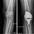연골 닳아 없어지면 인공관절 수술 필요 ,지긋지긋한 관절염 & 인공관절 수술 이미지