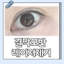 수지도 제거한 눈알 점, 전주 결막모반 레이저 제거 후기