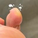 새소망정형외과의원 | 수술, 발가락 휨 수술, 새끼발가락 교정수술, 발가락수술 후기, 최우진 정형외과 수술 후기, 소건막류 수술