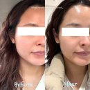 청구상인타운아파트노인정 | 대구 상인동 에스테틱 뷰티시아 : 자극없이 광나는 피부! 물광 LDM 물방울리프팅 관리 솔직후기