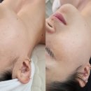 고운미 피부관리 | [익산 고운미에스테틱] 수분진정 관리 비포&애프터 후기 (익산피부관리실)