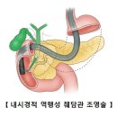카롤리병[Caroli’s disease]소화기질환 이미지