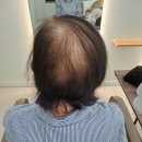 가발 쓰고 커트까지? 자연스럽게 완성된 증모 후기 — 벨라헤어