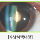 늘푸른임안과의원 네이버블로그