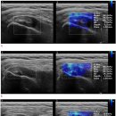 Re: shear wave elastography를 이용하여 극상근 건 파열 만성도 진단 2020 이미지