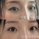 바른정한약국 | 압구정 눈밑지 후기 : 다크서클 고민 눈밑지방재배치로 해결: 일주일차 후기