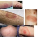 “Lyme disease (라임병)”은 진드기에 의해 전염되는 세균 감염 질환입니다