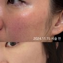 이지에프올로지의원 | [홍조, 문제성 피부] 청담동 피부과 리라젠 스킨부스터 후기 (+7일 후기, 내돈내산) 이지에프올로지의원
