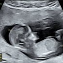 동부제일병원 | [12주] 동탄제일병원 1차 기형아 검사 후기