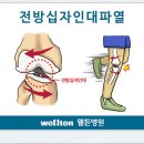 전방십자인대파열, 관절내시경, 관절경수술잘하는곳, 무릎수술, 관절통증, 전방십자인대수술재활 이미지