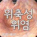 급성 위염의 진화(진행) 과정 이미지