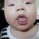 미뇽 | 아기 침독 땀띠 관리 후기｜앙또미뇽 판테놀 아토패치 사용해본 후기