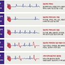 심장이 날뛰는 '부정맥'… 돌연사·뇌졸중의 주범입니다! 이미지