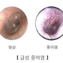 중이염 증상 성인 만성 중이염 원인 관리방법 이미지