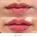 라두스의원 | 노원 상계 중계 피부과 입술필러 잘하는곳 입술 맛집