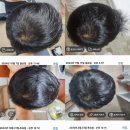 여름의원 | 당진 제일의원 탈모약 후기(효과,부작용,가격,여름휴가,휴진)
